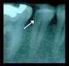Fig 1. Obtaining a pretreatment pulpal and periradicular diagnosis on tooth No. 29 before restorative treatment will allow the clinician to properly treat the dental pulp if it is exposed during caries removal.