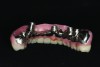 Fig 16. Screw-retained fixed complete denture in wax try-in phase with concave tissue surface.
