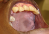 Figure 1. Kaposi’s sarcoma, oral lesions (courtesy of dentalcare.com)