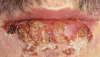 Figure 2. Herpes, lips (courtesy of dentalcare.com)