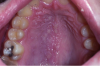 Figure 3. Herpes Zoster, unilateral on palate (courtesy of dentalcare.com)