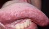 Figure 4. Hairy Leukoplakia, lateral border of tongue (courtesy of dentalcare.com)