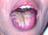 Figure 5. Pseudomembranous candidiasis (courtesy of dentalcare.com)