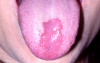 Figure 6. Erythematous candidiasis (courtesy of dentalcare.com)