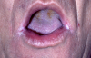 Figure 7. Angular cheilitis (courtesy of dentalcare.com)