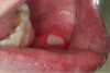Figure 8. Aphthous Ulcer (courtesy of dentalcare.com)