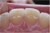 (4.) CR/MIP discrepancies are very common and are major factors leading to excessive tooth-to-tooth abrasion.