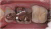(7.) “Ditching” from GERD around existing restorations may be noted upon examination.