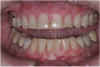 (11.) A patient presented with advanced generalized wear of her anterior teeth, and was displeased with their overall appearance because of their color and wear.