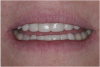 (19.) The provisional restorations show the vertical and horizontal changes in the incisal edge position.
