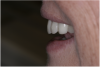 (21.) The provisional restorations show the vertical and horizontal changes in the incisal edge position.