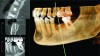 Figure 1 An integrated implant model with the volume rendering of a CBCT scan for implant planning purposes.