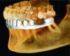 Figure 2 Integration of an optical scan of the mandible into the volume rendering of a CBCT scan.