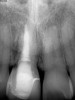 Fig 7. Preoperative radiograph showing previous endodontic therapy on tooth No. 8.