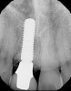 Fig 11. Radiograph of healed implant site No. 8 at 3 months.