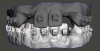 Fig 18. Scans of patient while still in orthodontic brackets.