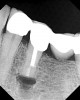 Fig 5. Postoperative radiograph of tooth No. 20 after microsurgery and retro-filling.