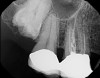 Fig 7. 2D radiograph of tooth No. 3.