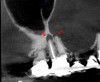Fig 8. 3D CBCT image of tooth No. 3 revealing hidden periapical pathology.