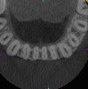 Fig 9. 3D CBCT image of mandibular incisors with two canals.