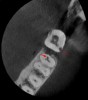 Fig 10. 3D CBCT image of tooth No. 18 (external resorption) and tooth No. 19 (internal resorption).