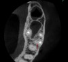 Fig 11. 3D CBCT image of an untreated MB2 canal in tooth No. 14.