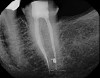 Fig 17. Postoperative obturation radiographs after multisonic ultracleaning technology, revealing complex and intricate canal anatomy.