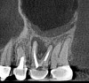 Fig 19. Preoperative 3D CBCT image before retreatment of tooth No. 14.