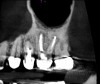 Fig 20. 3D CBCT image of tooth No. 14 at 4 months after single visit retreatment using multisonic ultracleaning technology.