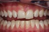 Fig 3. Retracted photograph, teeth apart.