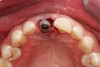 Fig 9. Occlusal view, implant placement after extraction, buccal plate intact.