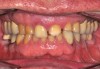 (2.) Pre-treatment anterior bite.