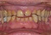 (4.) Postorthodontic anterior bite.
