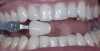 Fig 2. Preoperative whitening photograph with shade tab that matches pre-existing color.