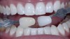 Fig 6. The teeth of the patient shown in Figure 1 and Figure 2 have whitened all the way to the whitening shade tab 010.