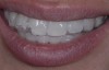 Fig 8. The at-home trays, containing a desensitizing and remineralizing gel, were placed immediately after the Zoom whitening was completed.