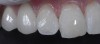 Fig 11. Postoperative photograph showed seamless, undetectable transition from tooth to restoration.