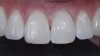 Fig 12. After whitening and prior to composite augmentation.