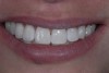 Fig 13. Patient’s smile after whitening. Note the minimally invasive, imperceptible restorations.