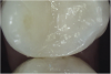 Fig 9. The remaining tooth structure supported a bonded intracoronal direct resin-based composite restoration of tooth shown in Fig 8.