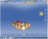 Figure 4 The CAD software proposed a restoration for tooth No. 9 that was an exact replica of its preoperative shape and contours.