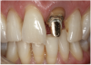 Figure 8 A patient presented with a fractured porcelain crown on tooth No. 9.
