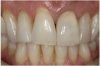 Figure 13 The crown was stained and glazed to match tooth No. 8, then adhesively cemented following patient approval.
