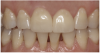 Figure 18 View of the restorations after adhesive resin cementation.