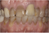 Figure 19 A patient presented with an uneven smile, discolored teeth, and insufficient tooth display when smiling.