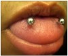 Figure 4. Dorsolateral tongue piercing.
