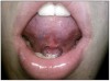 Figure 10. Web piercing.