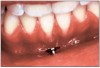 Figure 21. Gingival recession.