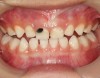 Fig 5. Use of 38% SDF to arrest coronal caries in primary teeth of a young child. The arrested carious lesion had a hard, blackened, and impermeable layer.