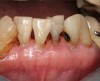 Fig 6. Use of 38% SDF to arrest root caries in permanent teeth of an elderly patient: the arrested root carious lesions were hard to probe.